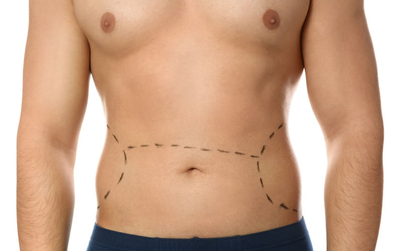 Chirurgie de la silhouette